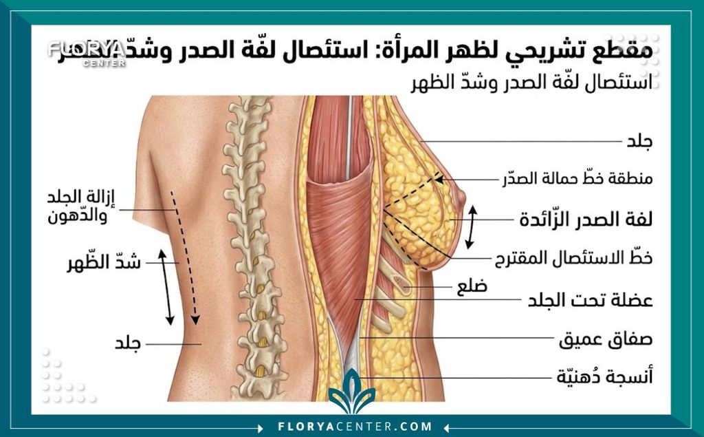 شد الظهر المترهل 2 رسم توضيحي طبي دقيق لطبقات الجلد والدهون في الظهر، يشرح تقنية استئصال الدهون وشد الظهر المترهل جراحياً.