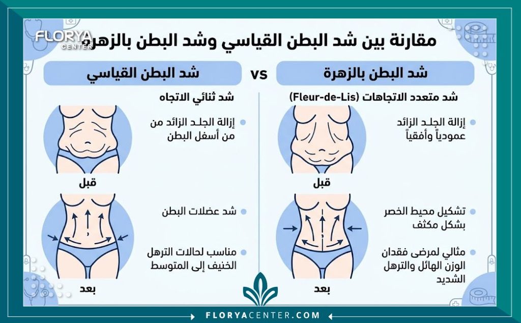 شد البطن المقلوب (Fleur-de-Lis) 3 إنفوجرافيك طبي يقارن بين عملية شد البطن التقليدي وشد البطن المقلوب لعلاج الترهل الشديد جداً بعد فقدان الوزن.