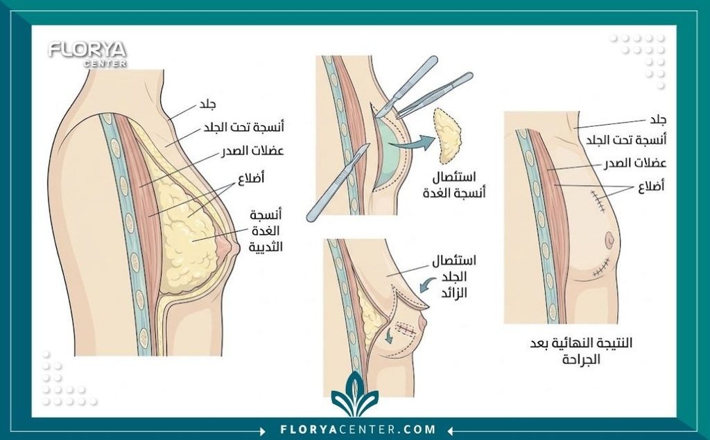 شد ترهلات الصدر للرجال (تثدي مع ترهل) 2 رسم توضيحي طبي مفصل يشرح التشريح الداخلي لعملية إزالة التثدي وشد ترهلات الصدر للرجال بعد فقدان الوزن.