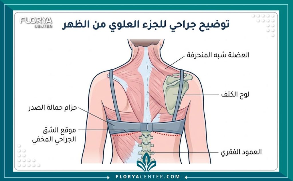 رسم توضيحي طبي يوضح مكان الشق الجراحي المخفي بدقة تحت حمالة الصدر في عملية شد الظهر.