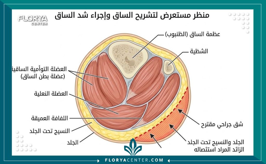 رسم توضيحي طبي دقيق يشرح تشريح عضلات بطة الساق ومناطق استئصال الجلد المترهل خلال جراحة شد السمانة.