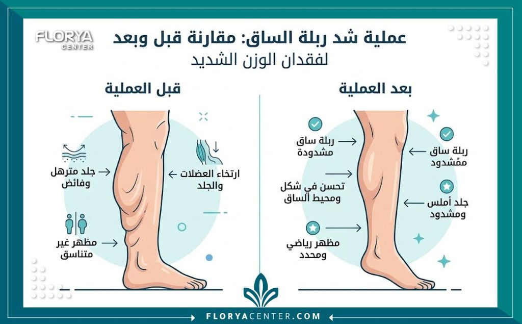 إنفوجرافيك يوضح الفرق وشكل الساق قبل وبعد عملية شد ترهلات الجزء السفلي من القدم بعد فقدان الوزن.