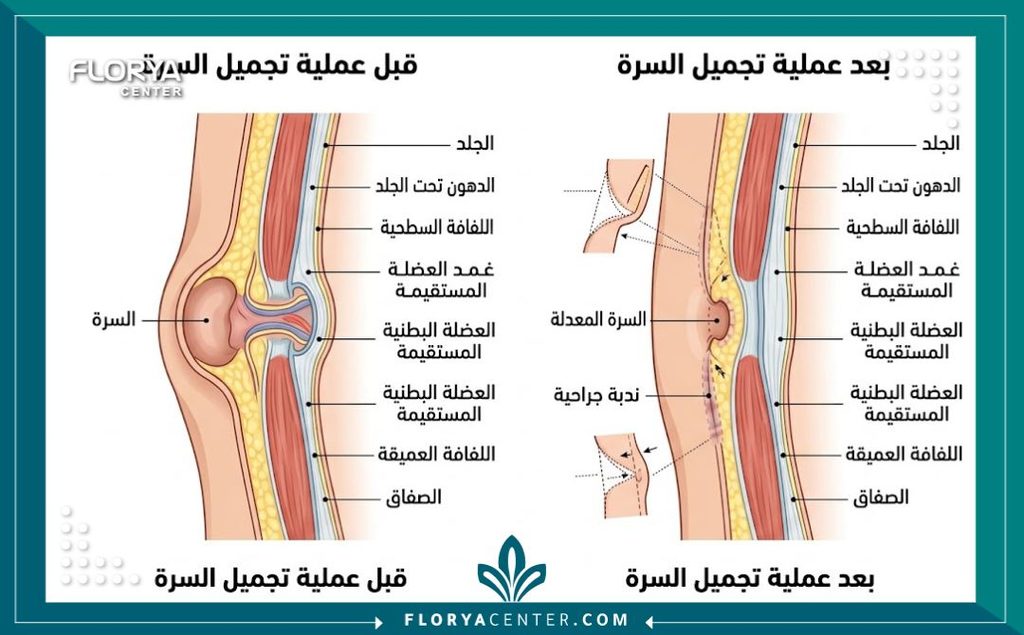 رسم توضيحي طبي يوضح تشريح جدار البطن وكيفية إصلاح السرة الحزينة عبر جراحة تجميل السرة.