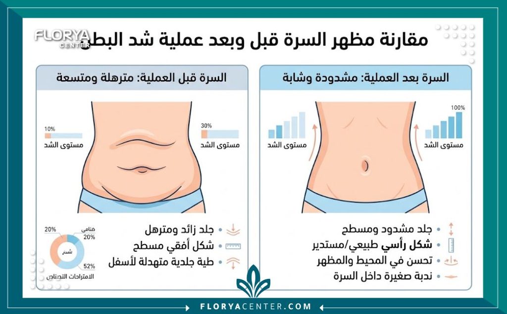 إنفوجرافيك يقارن بين السرة المترهلة بعد الولادة وشكل السرة المشدودة بعد عملية التجميل.