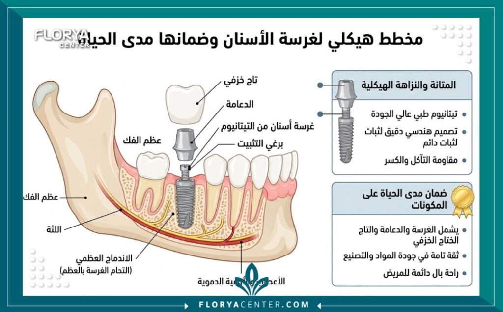 ضمان زراعة الاسنان في تركيا 2 رسم توضيحي لأجزاء زراعة الأسنان المشمولة في الضمان الطبي في تركيا.