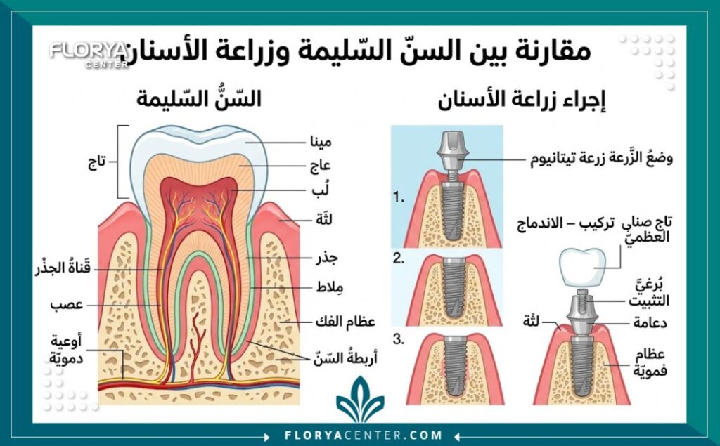رسم توضيحي طبي لتركيب زراعة الأسنان، أحد أهم العلاجات التي يقدمها دكتور أسنان سوري في اسطنبول.