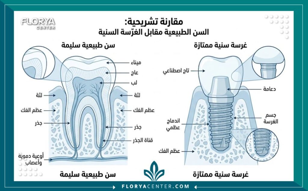 رسم توضيحي دقيق لتركيب الأسنان وزراعة الأسنان في أفضل عيادات طب الأسنان في تركيا.