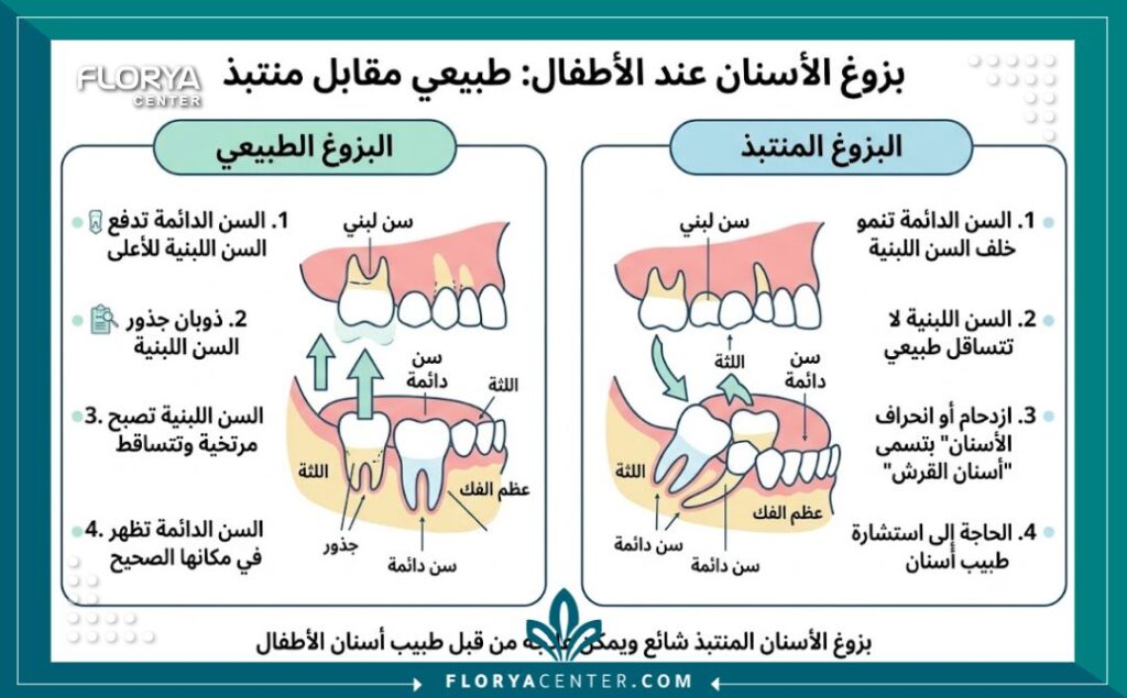 إنفوجرافيك يقارن بين التبديل الطبيعي للأسنان وحالة أسنان القرش عند الأطفال التي تتطلب خلع السن اللبني.