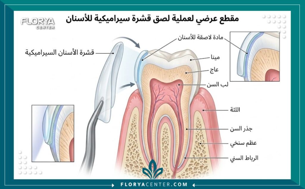 رسم طبي توضيحي يظهر تشريح السن وكيفية تركيب القشور الخزفية وعدسات الفينير للاسنان.