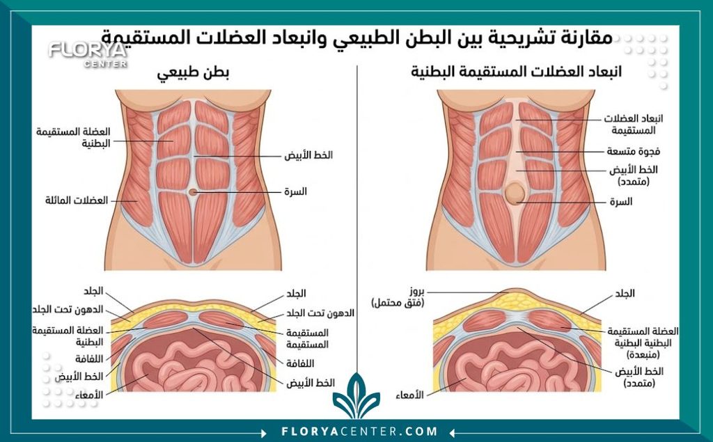 علاج الانفصال العضلي للبطن بعد الولادة 2 رسم توضيحي طبي يوضح شكل عضلات البطن الطبيعية مقارنة بحالة الانفصال العضلي للبطن بعد الولادة (Diastasis Recti).