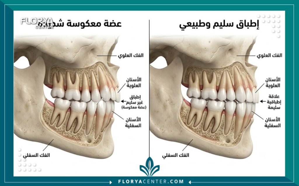 رسم توضيحي طبي دقيق يقارن بين شكل الفك في حالة العضة المعكوسة وإطباق الأسنان الطبيعي والصحي.