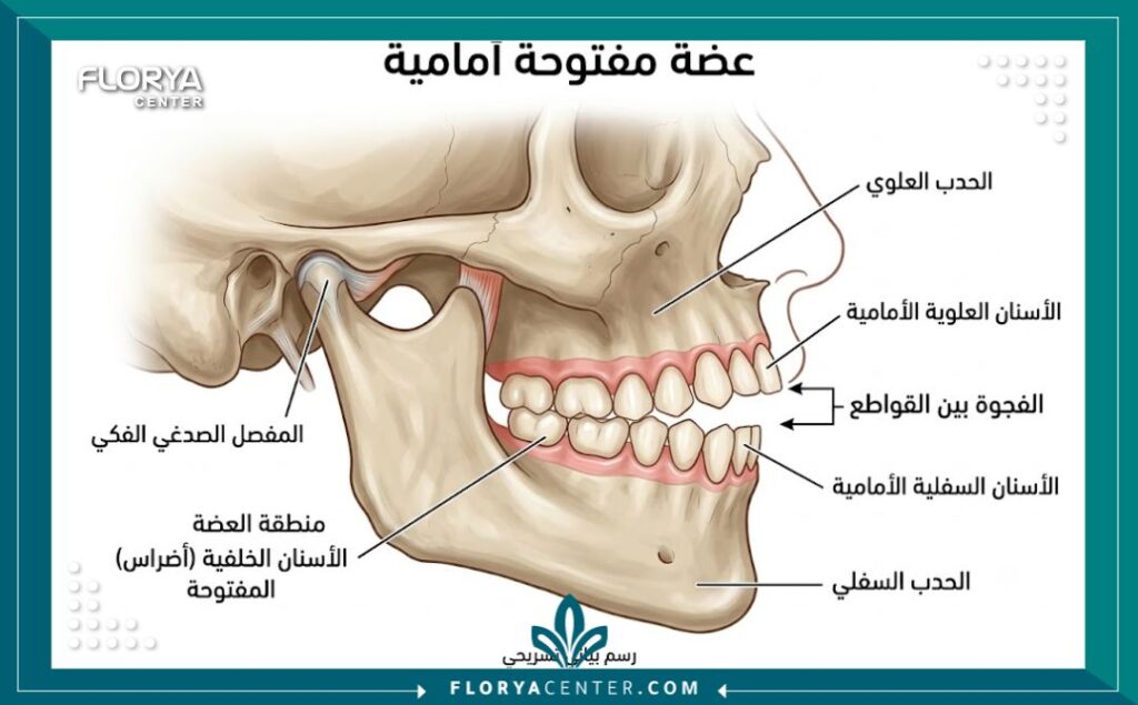 رسم توضيحي طبي يشرح تشريح الفك وحالة العضة المفتوحة الأمامية التي تمنع قضم الطعام.