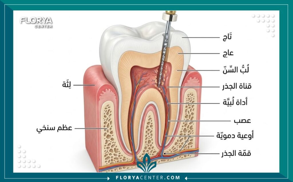 رسم توضيحي طبي لتركيب السن الداخلي يوضح عملية سحب العصب وتنظيف قنوات الجذور بدقة واحترافية.