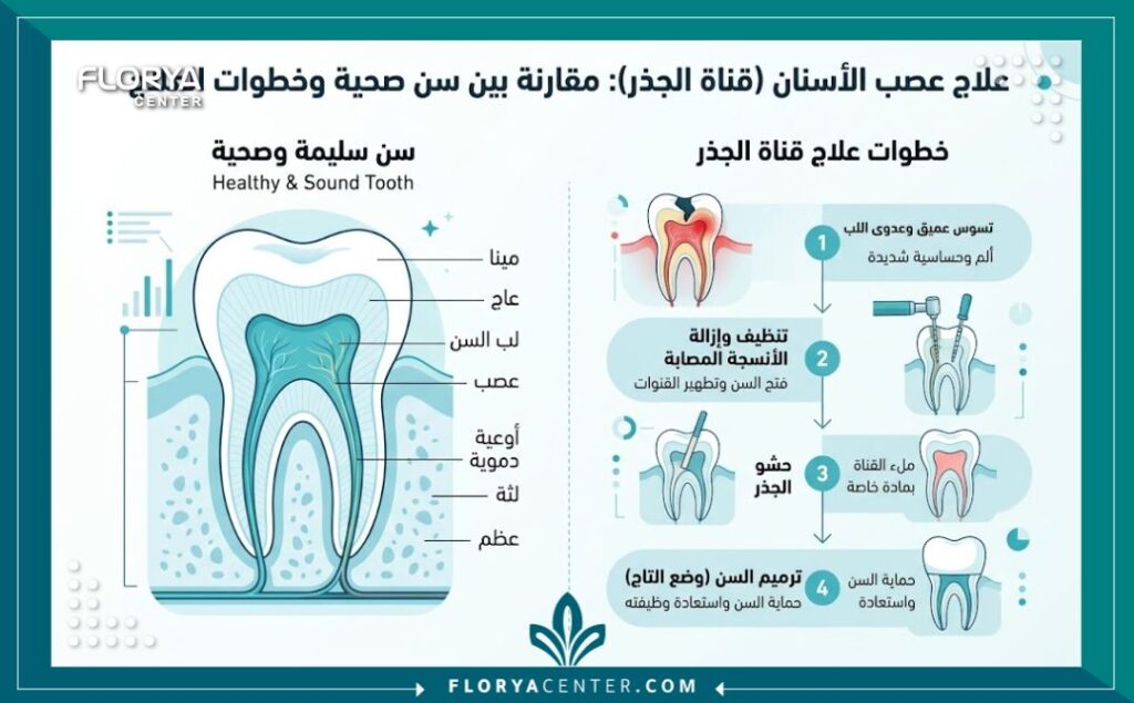 إنفوجرافيك يوضح الفرق بين السن السليم والسن المصاب بالتسوس العميق وخطوات علاج جذور الاسنان خطوة بخطوة.