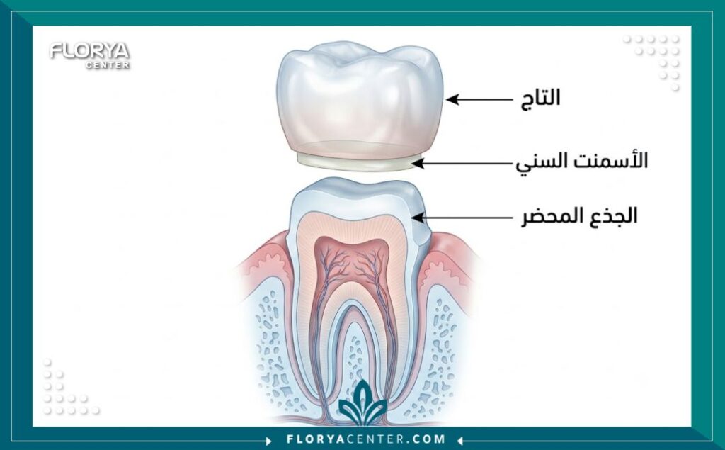 رسم توضيحي طبي لتشريح السن يوضح الدعامة وطبقة الصمغ وأسباب سقوط تلبيسة السن.