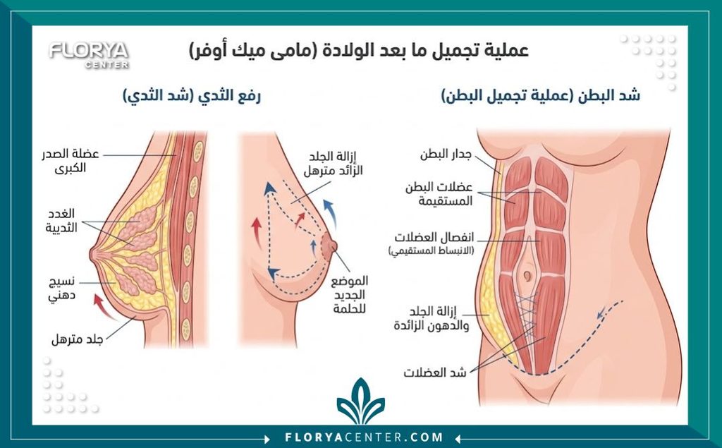 رسم توضيحي طبي يشرح مناطق تدخل عمليات تجميل ما بعد الأمومة والتي تشمل شد البطن المترهل ورفع الثدي.