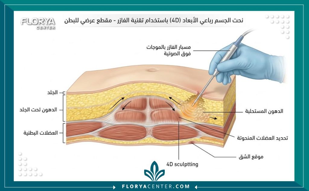 رسم توضيحي طبي لتقنية الفيزر 4D لشفط الدهون ونحت العضلات بدقة.