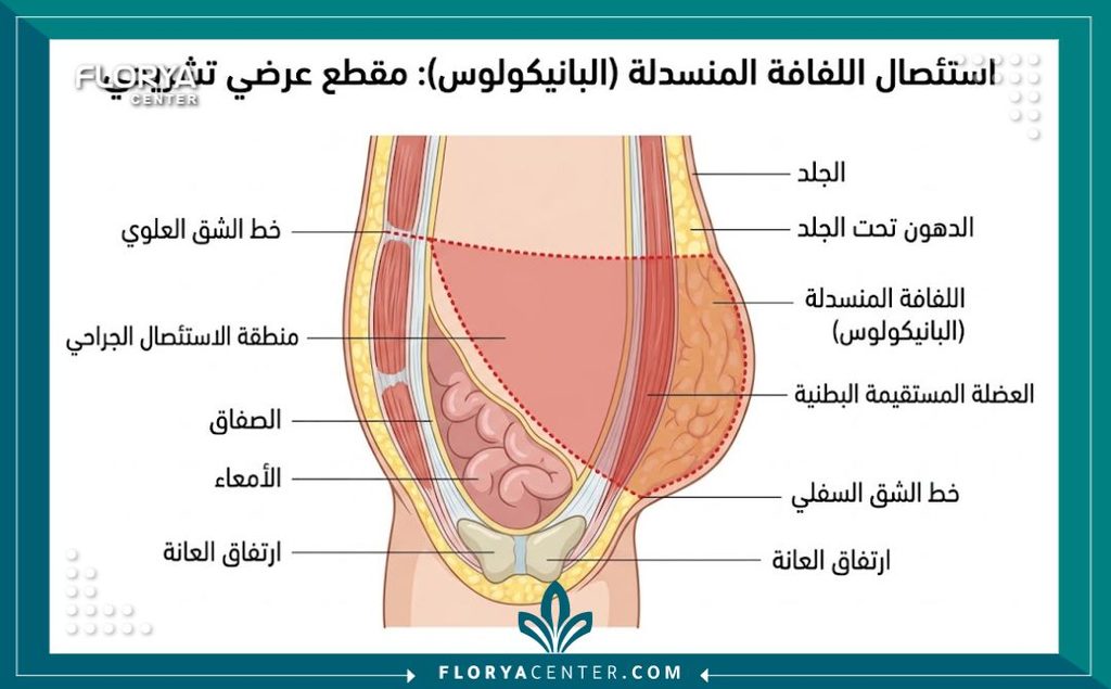 عملية استئصال السبلة الشحمية 2 رسم توضيحي تشريحي يوضح مريلة البطن ومناطق القص في عملية استئصال السبلة الشحمية.
