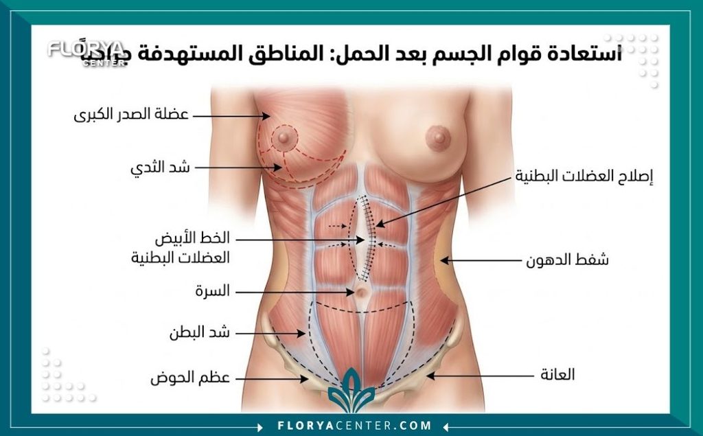 رسم توضيحي طبي يشرح العضلات والمناطق المستهدفة في عملية استعادة قوام ما قبل الحمل مثل شد البطن ورفع الثدي.