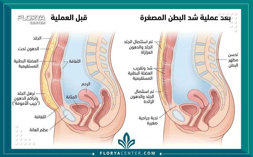 عملية التخلص من "بطن الأمومة" 2 رسم توضيحي طبي يوضح تشريح منطقة أسفل البطن وعضلاتها قبل وبعد عملية شد ترهلات الأمومة والتخلص من الجراب.