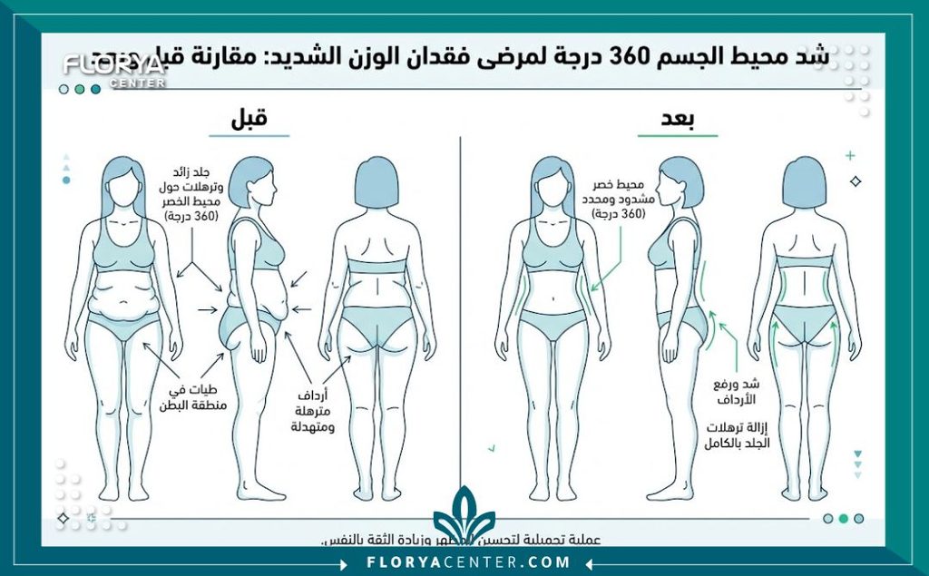 عملية الحزام الدائري لشد الجسم 3 إنفوجرافيك يوضح التخلص من ترهلات الجلد قبل وبعد عملية الحزام الدائري لشد الجسم بعد فقدان الوزن.