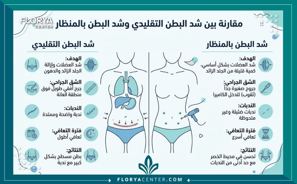 إنفوجرافيك يقارن بين شد البطن التقليدي وعملية الشد الجراحي الدقيق بالمنظار بدون شق العانة الطويل.