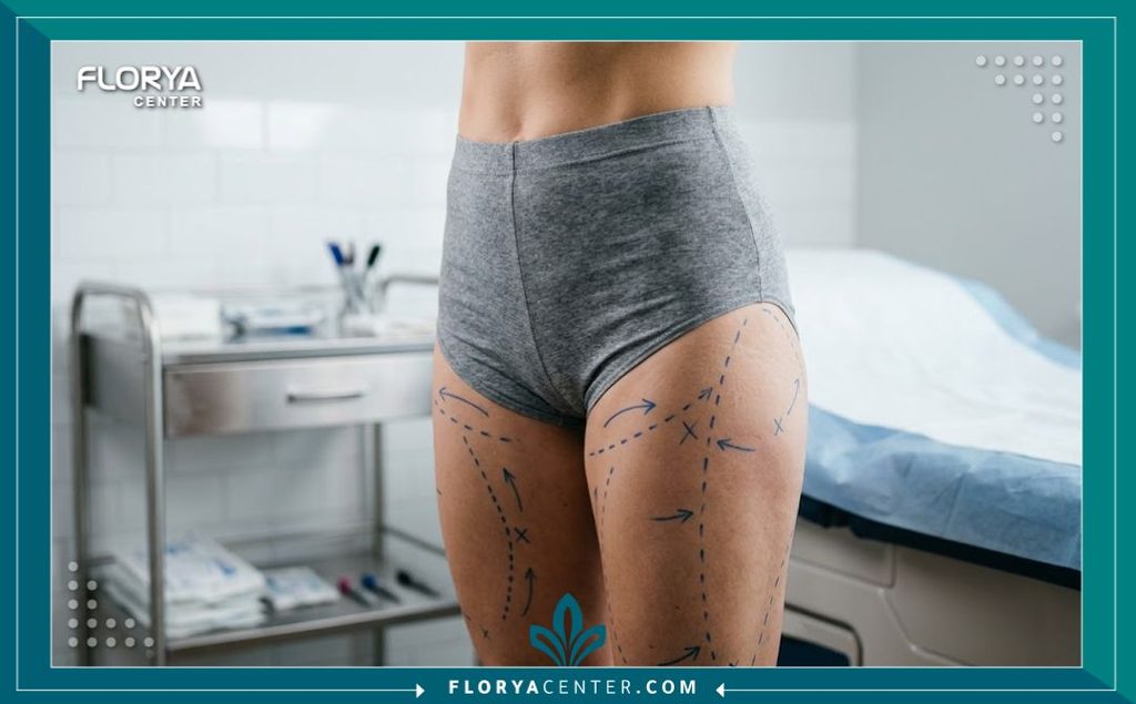 عملية شد الأطراف السفلية 5 طبيب جراحة تجميل يقوم بتحديد علامات الجراحة على الفخذين والأرداف قبل عملية شد الأطراف السفلية.