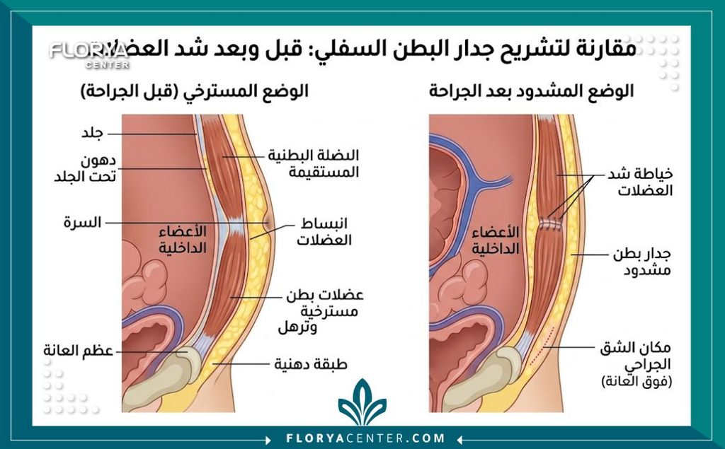عملية شد البطن المصغرة مع إصلاح العضلات 2 رسم توضيحي طبي يشرح تشريح منطقة أسفل السرة وإصلاح العضلات في جراحة شد البطن المصغرة.
