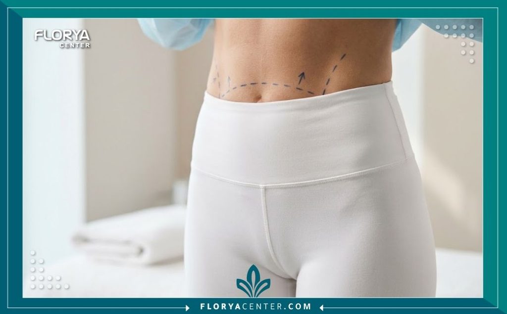 عملية شد العانة المترهلة (Monsplasty) 5 تحديد منطقة أسفل البطن والعانة بالخطوط الطبية استعداداً لعملية شد الترهلات وتنسيق القوام.