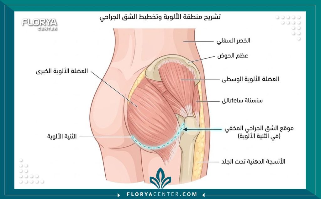 رسم توضيحي طبي يوضح مكان الشق الجراحي المخفي تماماً تحت خط البكيني في عملية شد الأرداف.