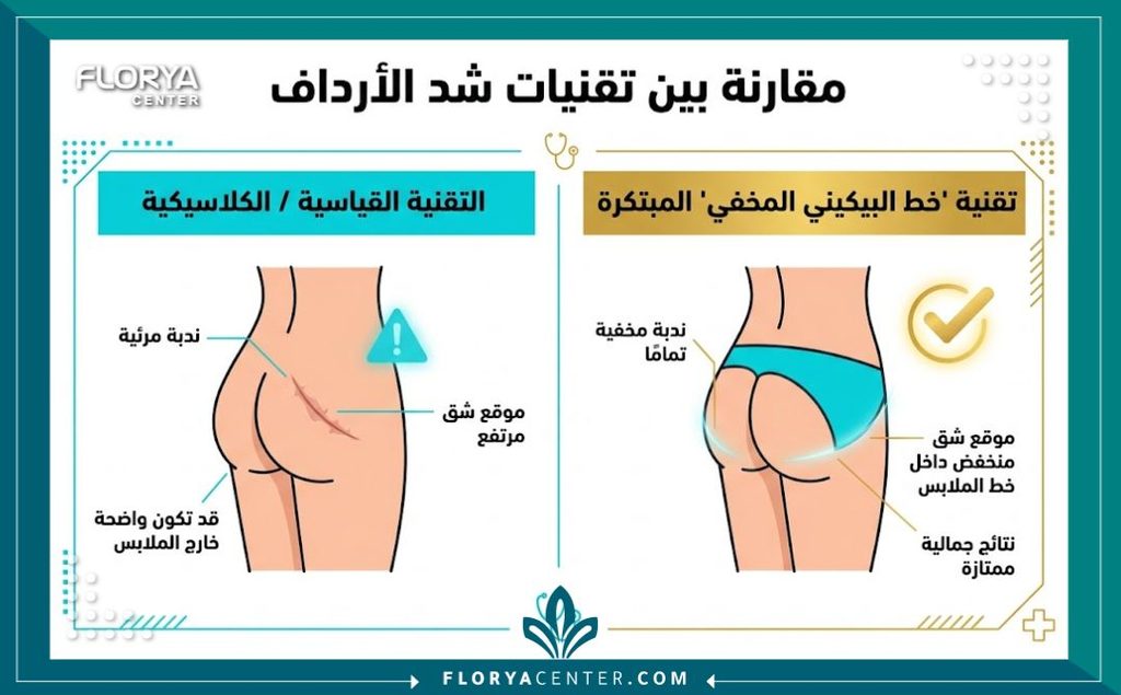 إنفوجرافيك يقارن بين ندوب الجراحة التقليدية ومميزات عملية شد المؤخرة المخفية بدون ندبات ظاهرة.
