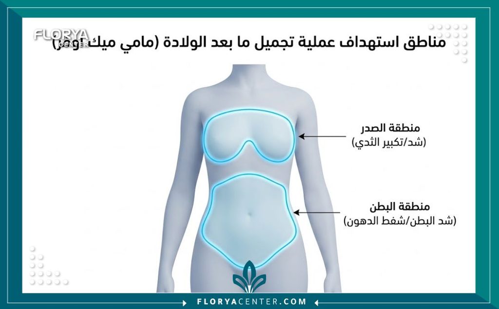 رسم توضيحي طبي يشرح المناطق المستهدفة في عملية المامي ميك أوفر لشد البطن ورفع الثدي.