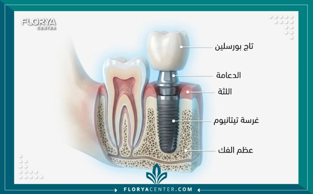 عيادات اسنان اسطنبول 2 رسم توضيحي طبي لخطوات زراعة الأسنان الدقيقة داخل أفضل مراكز طب الأسنان في تركيا.