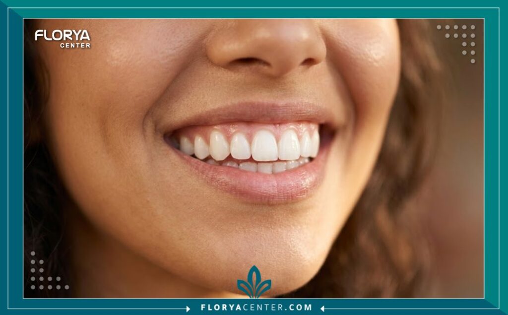 عيادات اسنان اسطنبول 5 ابتسامة هوليود ناصعة البياض لامرأة بعد نجاح عملية تجميل الأسنان في تركيا.