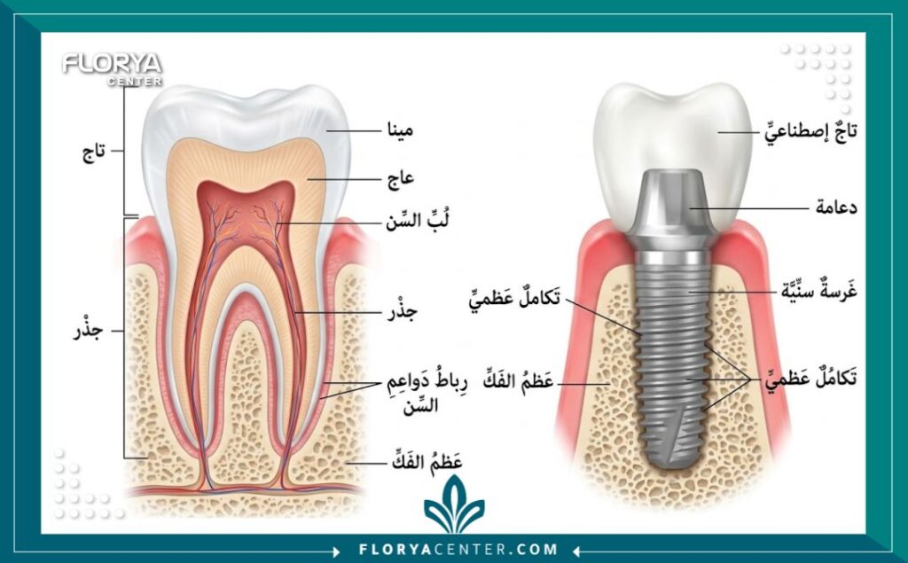 عيادات اسنان بتركيا 2 رسم توضيحي دقيق لتركيب زراعة الأسنان في مراكز تجميل الأسنان بتركيا