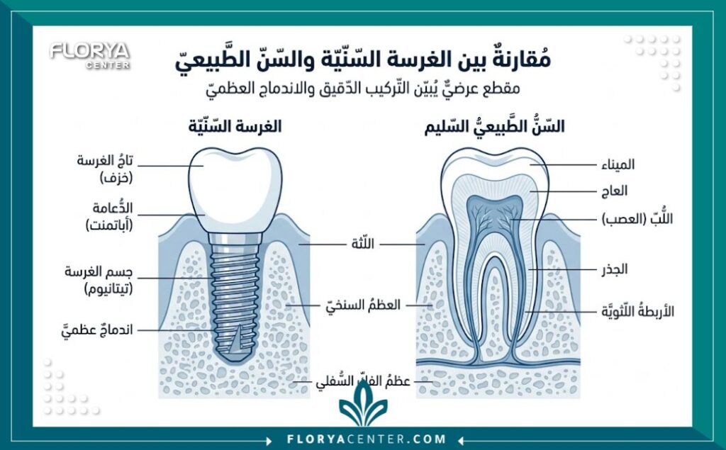 رسم توضيحي طبي لتركيب وزراعة الأسنان يوضح جودة المواد المستخدمة في عيادات الأسنان بتركيا.