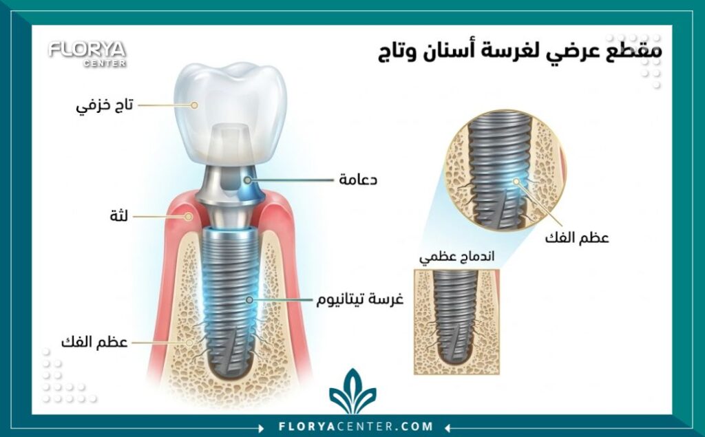 رسم توضيحي طبي لتركيب زراعة الأسنان والتيجان الفاخرة في أفضل عيادة أسنان بتركيا.