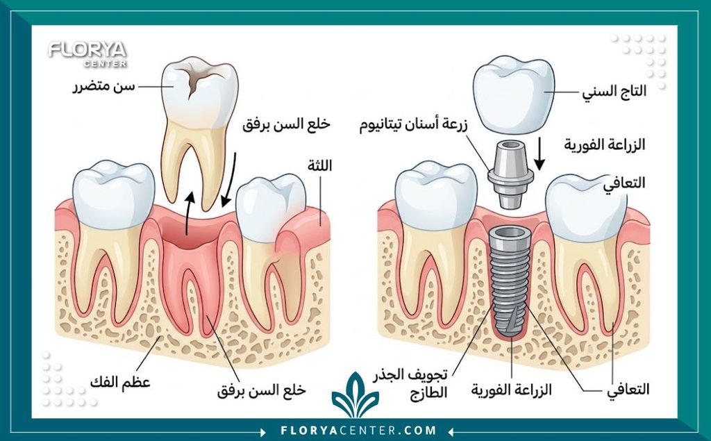 رسم توضيحي طبي يوضح وضع الزرعة في نفس الفراغ الجذري مباشرة بعد الخلع بتخدير واحد.