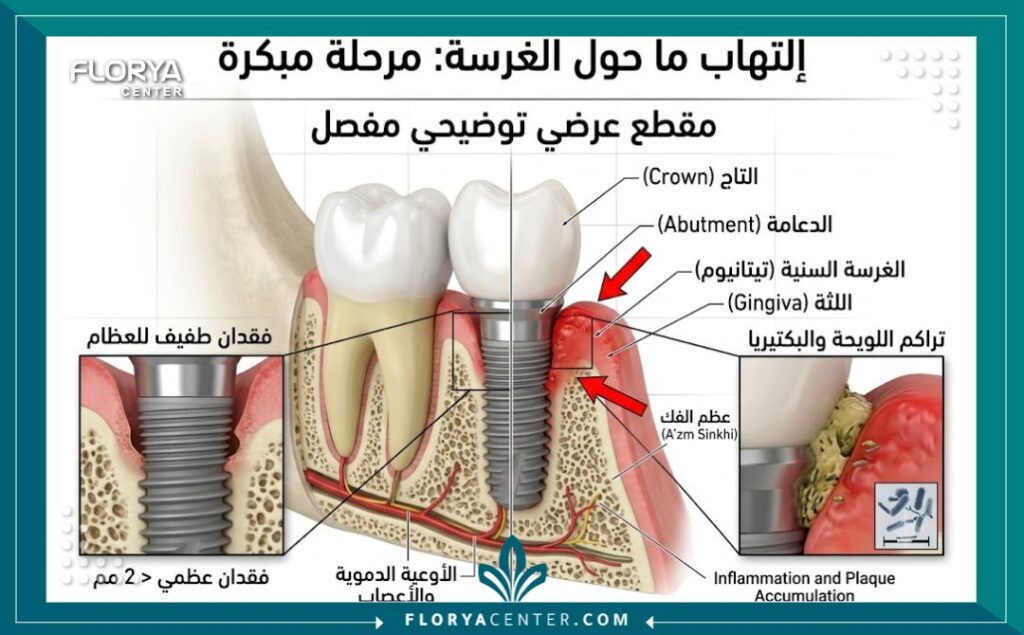 فشل زراعة الاسنان 2 رسم توضيحي طبي دقيق يوضح تراجع العظم والتهاب اللثة حول المسمار كأحد أهم أسباب فشل زراعة الأسنان.