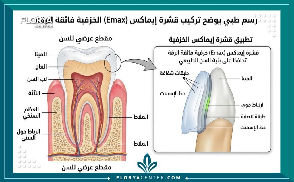 رسم توضيحي طبي يبين طريقة تركيب قشور فينير الايماكس الرقيقة على السن الطبيعي.