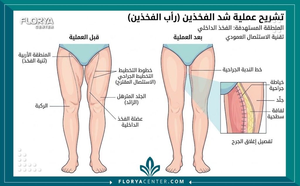 رسم توضيحي طبي يوضح أماكن قص الجلد الزائد من الفخذين الداخليين لعلاج الترهلات.