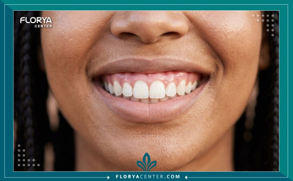 نتائج التنسيق الجمالي وتصميم الابتسامة بفضل تقنيات تجميل الأسنان