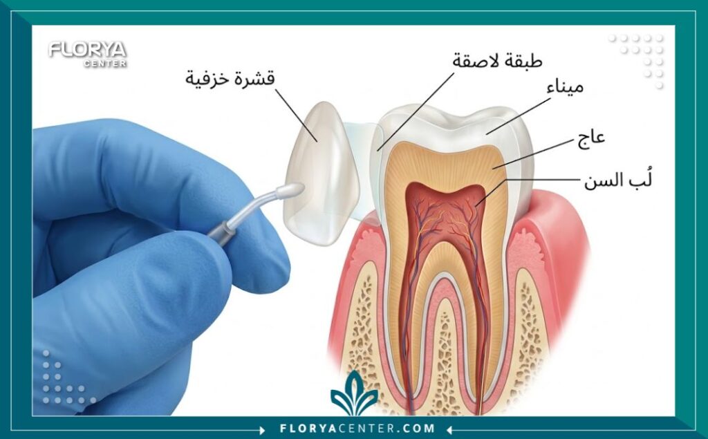رسم توضيحي طبي لخطوات تركيب قشور الفينير على الأسنان