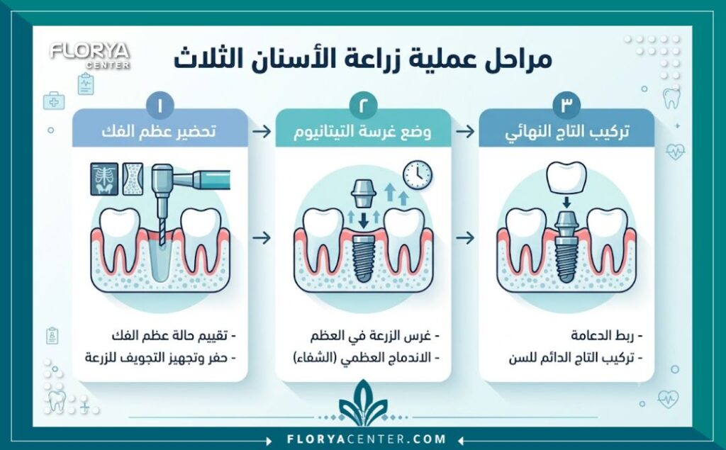 إنفوجرافيك يوضح خطوات ومراحل تركيب مسمار زراعة الاسنان وصولاً إلى تركيب التاج النهائي.