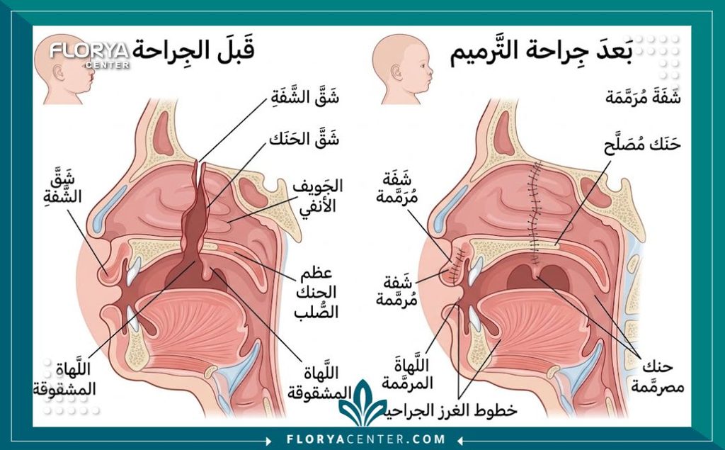 رسم توضيحي طبي دقيق لتشريح الفم يوضح حالة انشقاق سقف الحلق قبل وبعد العملية الجراحية الترميمية.
