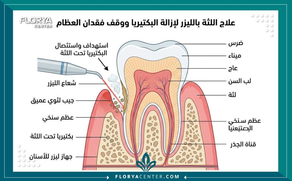 رسم طبي يوضح تشريح اللثة وكيفية إبادة البكتيريا تحت اللثة ووقف تآكل العظم باستخدام الليزر.