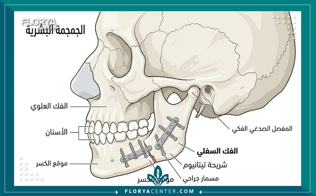 معالجة كسور الفك في تركيا 2 رسم توضيحي طبي يبين طريقة تثبيت كسور الفك بالصفائح المعدنية والبراغي بعد حوادث السير.