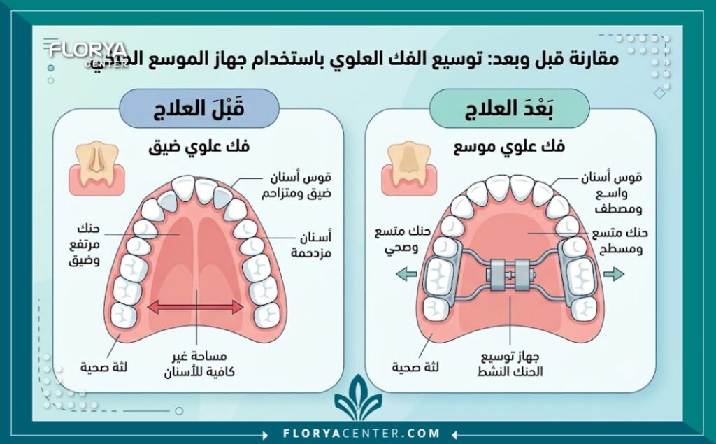 موسع الفك العلوي 3 إنفوجرافيك يقارن حالة الفك قبل وبعد استخدام موسع الفك العلوي لتجنب تزاحم الأسنان.