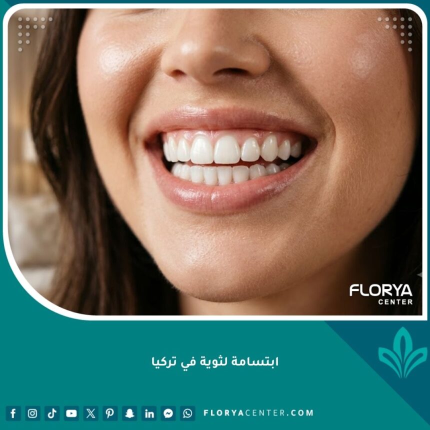 صورة مقربة لابتسامة مثالية وجذابة توضح النتائج الرائعة بعد علاج الابتسامة اللثوية في تركيا.