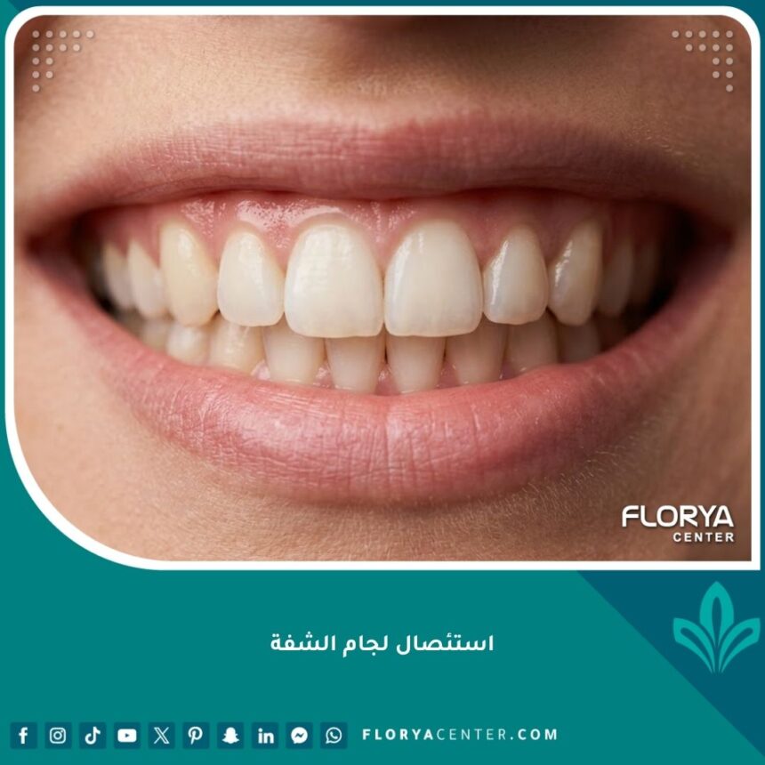 صورة مقربة لابتسامة مثالية تبرز جمال الأسنان وتناسقها بعد عملية استئصال لجام الشفة العلوية بنجاح.